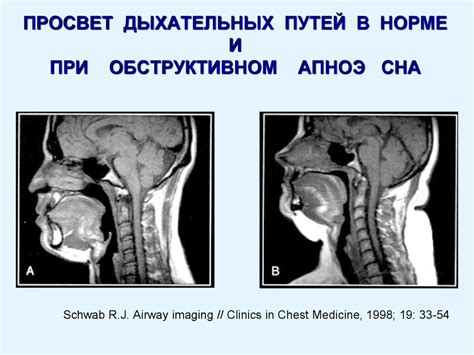 Синдромы обструктивного сноровки