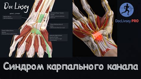 Синдром карпального канала