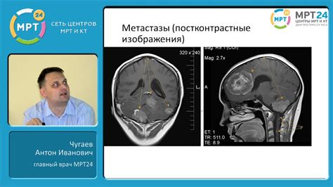 Синдром ложного мозга