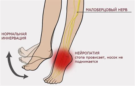 Синдром малоберцового нерва и периодические судороги