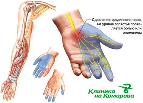 Синдром раздраженных нервов