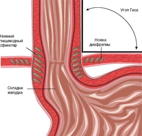 Слабый тонус нижнего пищевода сфинктера