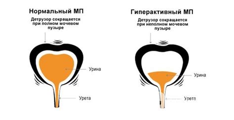 Снижение чувствительности мочевого пузыря