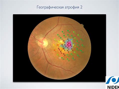 Снижение чувствительности сетчатки