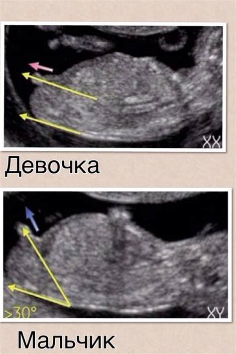 Советы по определению пола ребенка на 13 неделе беременности