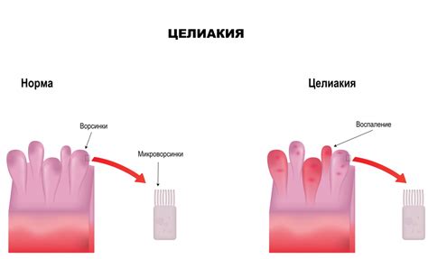 Современные методы лечения и предупреждения ихтитоза