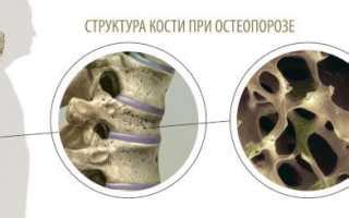 Сокращение плотности костей