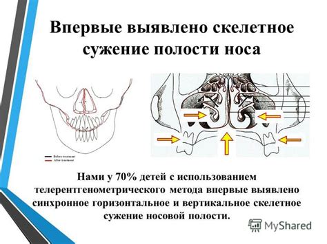 Сосудистые нарушения в носовой полости