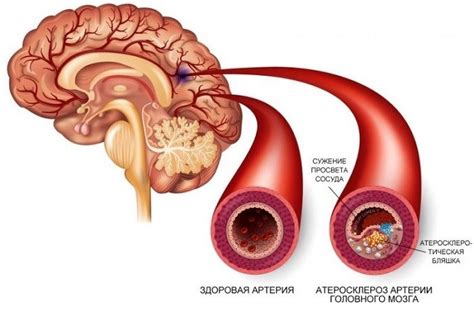 Сосудистые нарушения и периферический атеросклероз