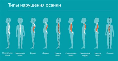 Спинальные проблемы и нарушения осанки