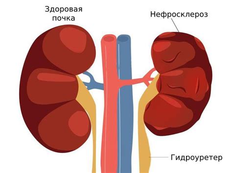 Спорт и нефроптоз