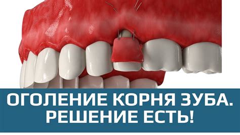 Способы предотвращения кровоточения десен