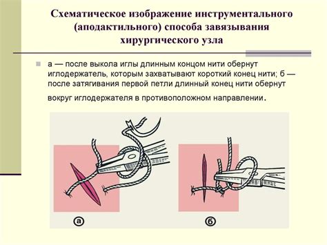 Способ 2: Использование хирургических швов