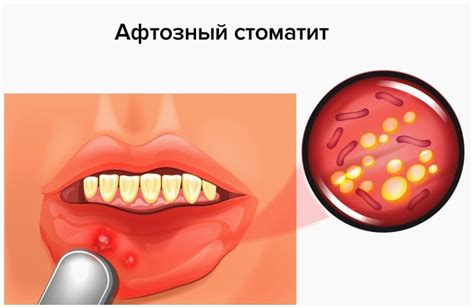 Стоматит у взрослых: причины, симптомы, лечение, профилактика