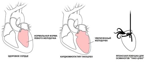 Стресс и его роль в формировании психосоматических заболеваний