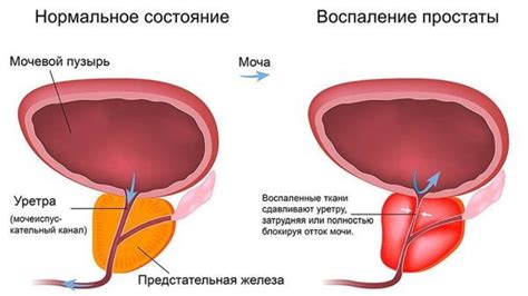 Стресс и подтекание мочи: взаимосвязь