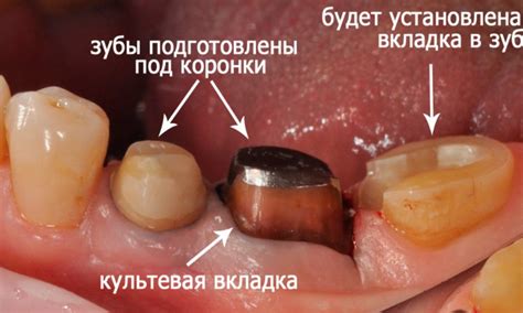 Техника установки штифта под коронку