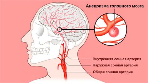 Типы аневризм головного мозга