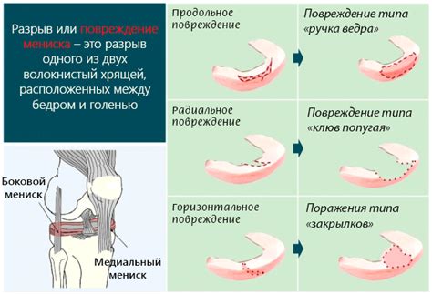 Травматические повреждения колена