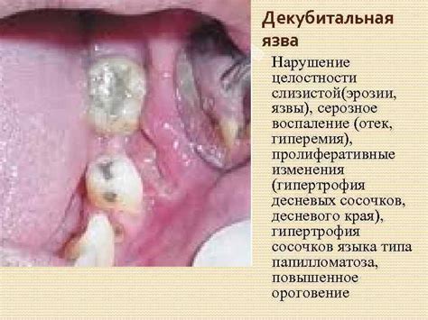 Травма и воспаление слизистой оболочки