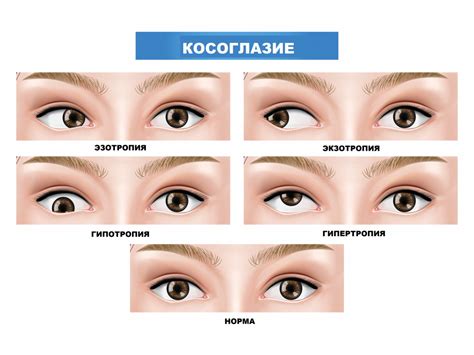 Травмы, хронические заболевания и косоглазие