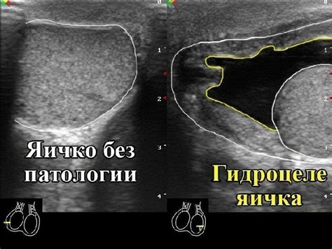 Травмы и повреждение яичек