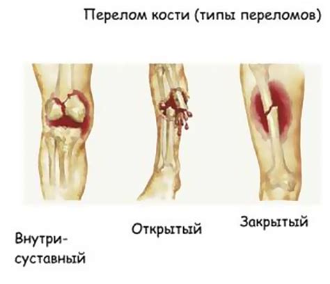 Травмы и повреждения суставов в прошлом