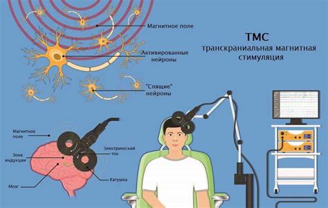 Транскраниальная магнитная стимуляция (ТМС) для лечения эпилепсии без применения лекарств