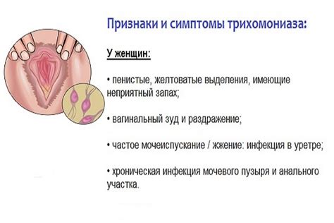 Трихомонада: симптомы и последствия