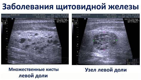 УЗИ-диагностика щитовидной железы у ребенка