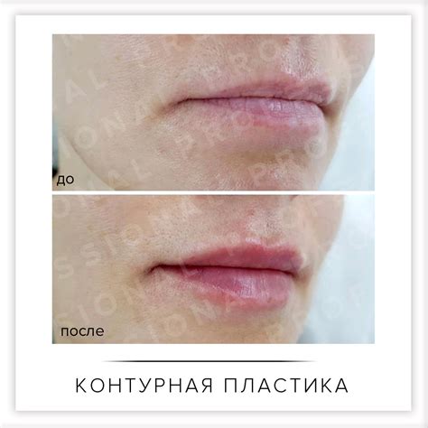 Увеличение губ: эффективные методы для подчеркивания естественной красоты