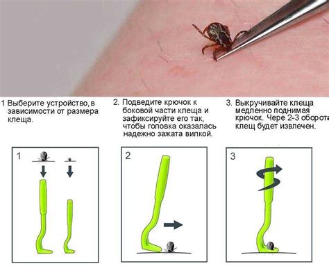 Удаление клеща с использованием пинцета