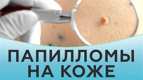 Удаление маленькой папилломы на коже: эффективные методы и способы