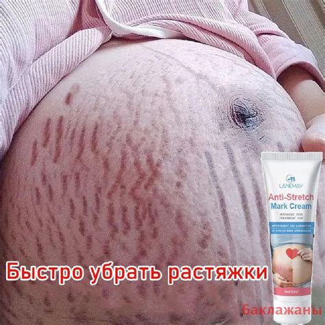 Удаление свежих растяжек после родов: эффективные методы и советы