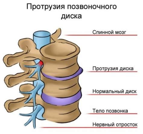 Улучшение кровообращения и питания межпозвонковых дисков