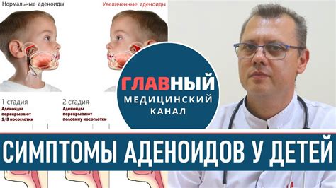 Ультразвуковая диагностика аденоидов у ребенка