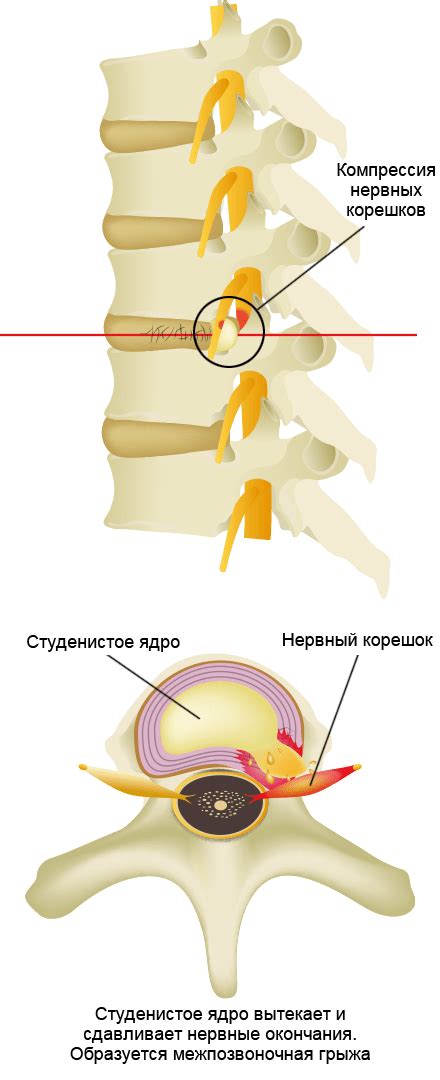 Уменьшение силы сжатия межпозвоночных дисков