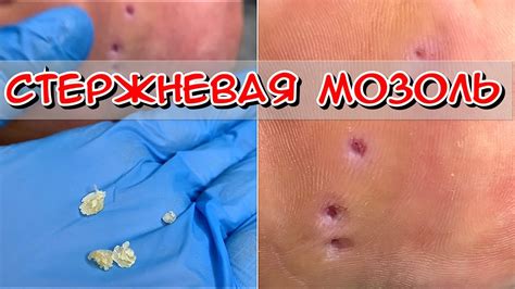 Универсальный метод удаления мозоли за один день без боли