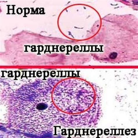 Уреаплазма и ее последствия для женщин