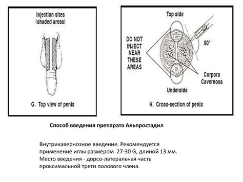 Уретровагинальная мышца и различные методики лечения эректильной дисфункции