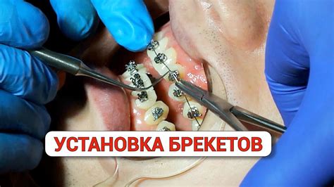 Установка брекетов