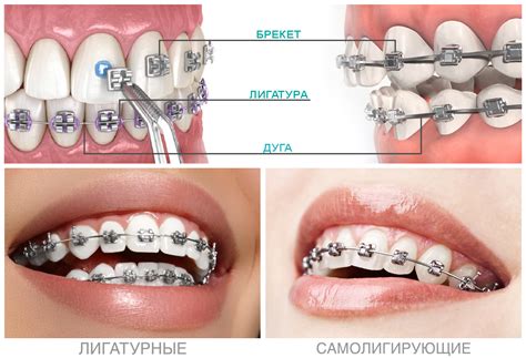 Установка Brackets