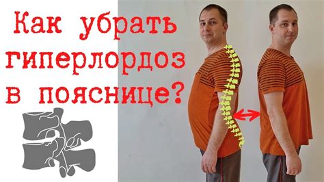 Устранение гиперлордоза поясницы: основные принципы