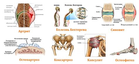 Утренняя жесткость и скованность суставов