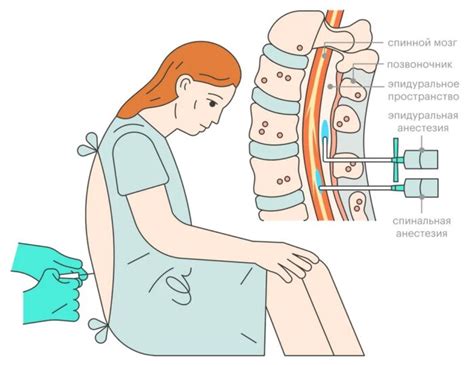 Уход за эпидуральной пункцией
