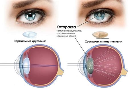 Ухудшение зрения и риск катаракты