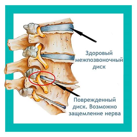 Ущемление нерва: