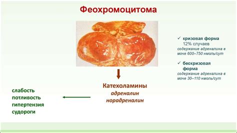 Феохромоцитома: симптомы и диагностика