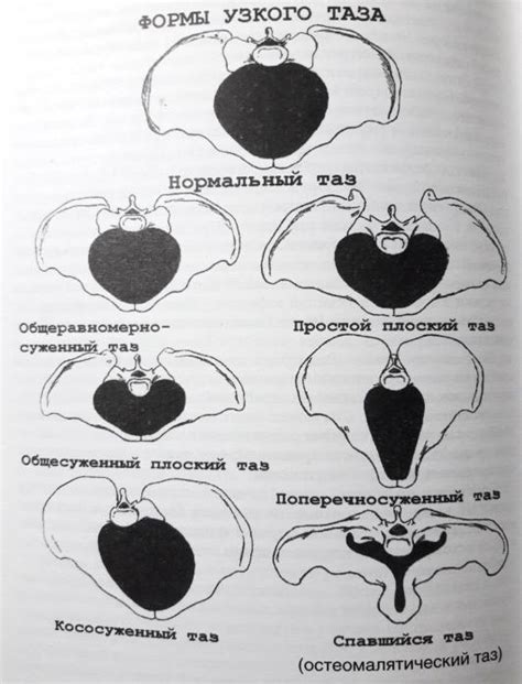 Физиологические признаки узкого таза