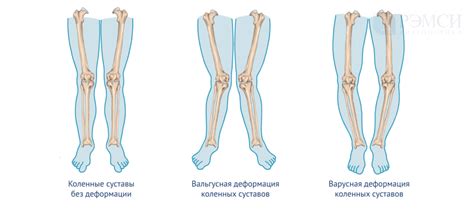 Физиология коленных чашечек у детей